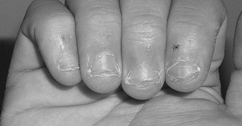 Nail Biting: Not just a habit but a health problem