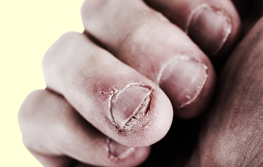 7 Gross Things That Happen When You Bite Your Nails