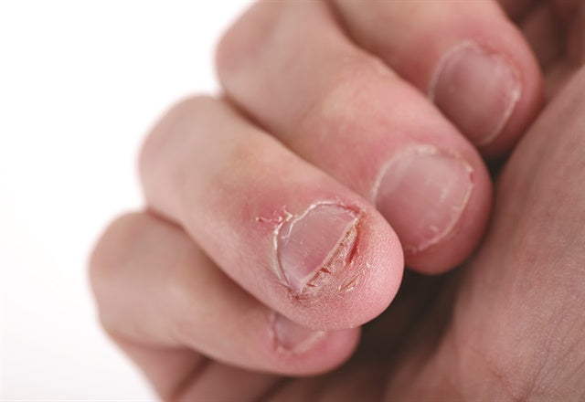 Dr. Stern discusses complications and concerns surrounding nail-biting, along with several effective treatment options